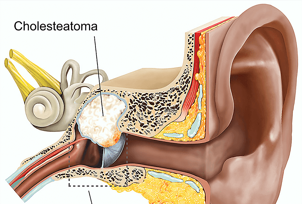 Холеастома. Холестеатома барабанной перепонки. Холестеатома отоскопия. Холестеатома среднего уха гистология. Холестеатома височной.
